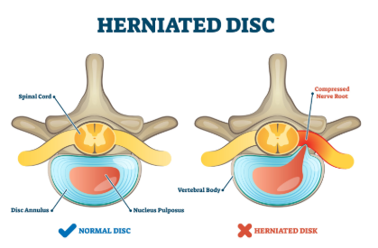 Herniated Disc