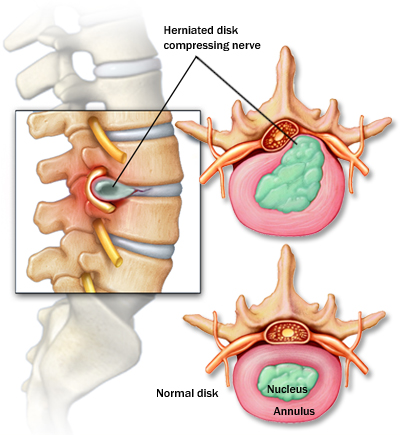 Disc Problem Vs Muscle Strain