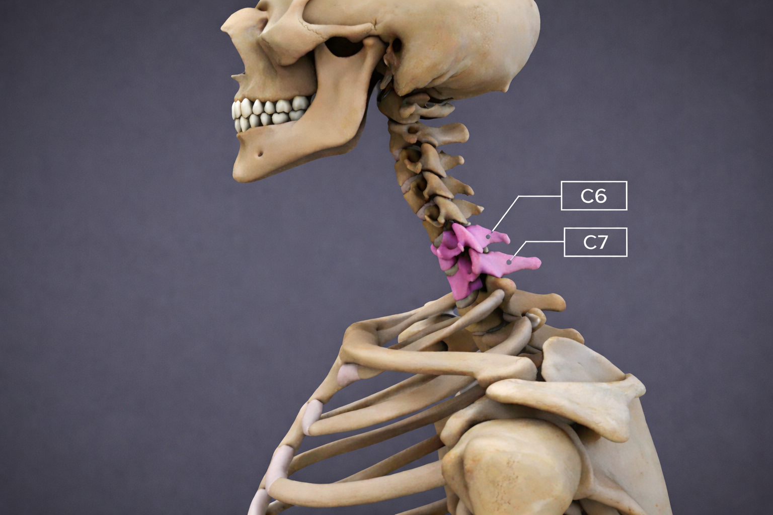 C6-C7 Disc Herniation